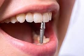 Имплантация зубов в Самаре