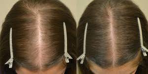 Лечение выпадение волос у женщин